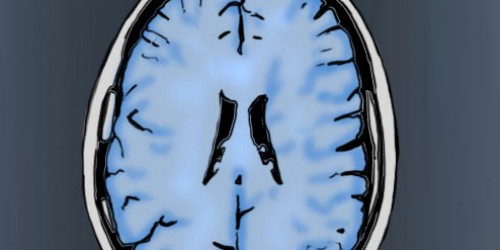 Maybe Alzheimer's Isn't Inflammatory, So What Is To Blame?