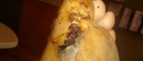 Cellulitis: Old Fashioned Cures Make A Comeback In A Nearly Post-Antibiotic World