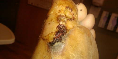 Cellulitis: Old Fashioned Cures Make A Comeback In A Nearly Post-Antibiotic World