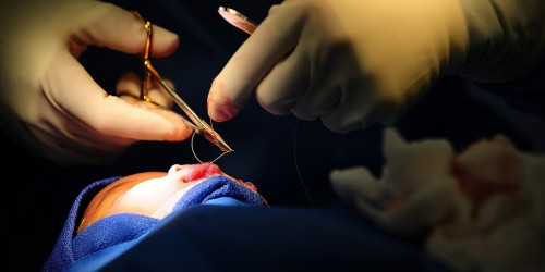 Cleft Lip And Cleft Palate: What To Expect