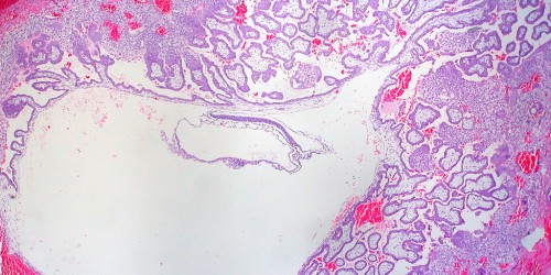 Conceiving After A Tubal Ectopic Pregnancy