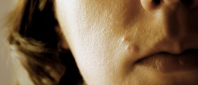 Mystery Pimple On Your Lip? Here's What It Could Be