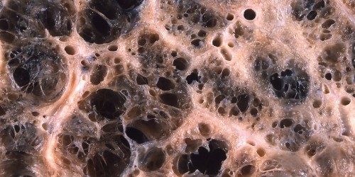 An Aspirin A Day Keeps Emphysema Away?