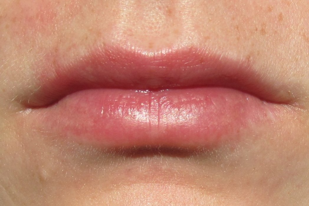 How to treat a mouth burn
