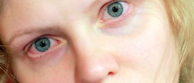 Pink Eye: Essential Things You Should Know About Conjunctivitis