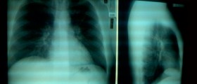 Agammaglobulinemia: A Rare And Devastating Autoimmune Disease