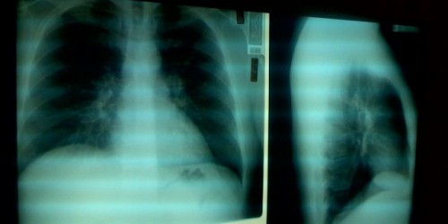 Agammaglobulinemia: A Rare And Devastating Autoimmune Disease