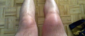 Reactive Arthritis: What Is It And How Can It Be Treated?