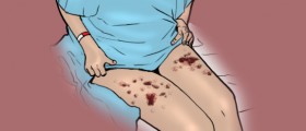 Sepsis: What You Need To Know
