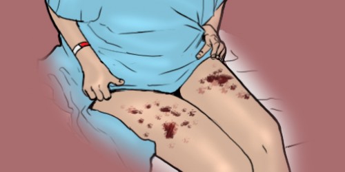 Sepsis: What You Need To Know