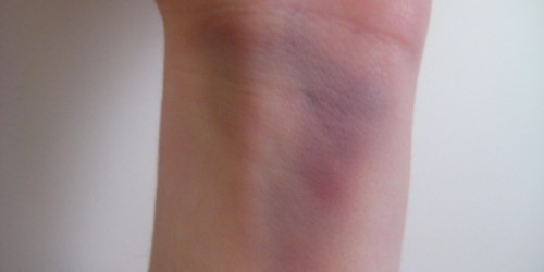 Living With Gaucher’s Disease