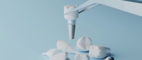 What Are Zygomatic Implants And Are They Suitable For Everyone?