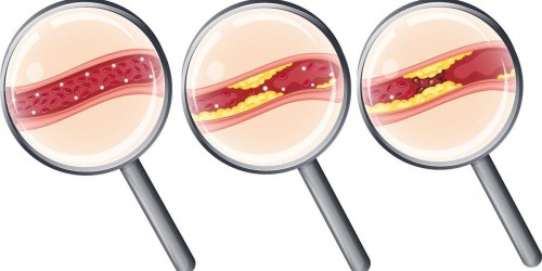 Atherosclerosis As A Major Cause Of Coronary Artery Disease: 7 Things You Should Know