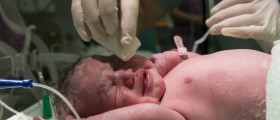 Congenital Heart Disease: What Is Tetralogy Of Fallot And How Does It Affect The Heart?