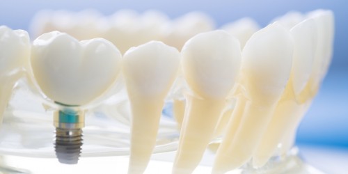 Want Dental Implants? Here's What You Should Know Before Seriously Considering Them