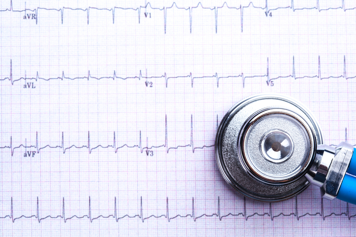 what-is-an-ekg-electrocardiogram-and-how-does-it-help-diagnose