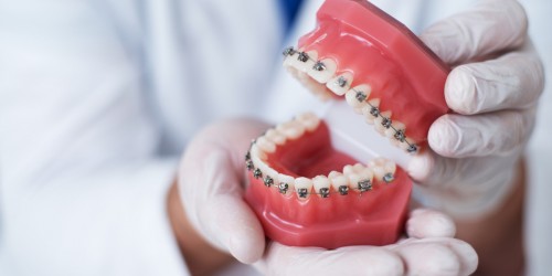 5 Types Of Braces: Which Ones Are Right For Your Child?