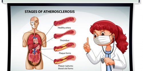 How Can High Cholesterol Lead to Atherosclerosis?
