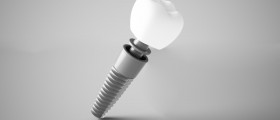Preparing For Dental Implants: What Side Effects Are most Common?