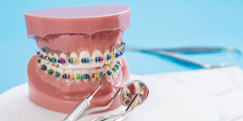 Preparing For The Orthodontist: 7 Things You Need To Know About Traditional Braces With Brackets