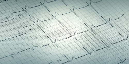Restrictive Cardiomyopathy: Causes, Symptoms, Diagnosis And Treatment