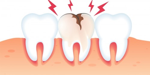 Toddler Tooth Decay: How To Treat Tooth Cavities Or Caries In Young Children?