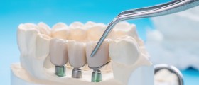 What Kinds of Crowns Can Be Placed On Dental Implants?