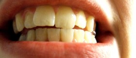 New Scientific Statement: Link Between Gum Disease And Heart Attack Does Not Exist