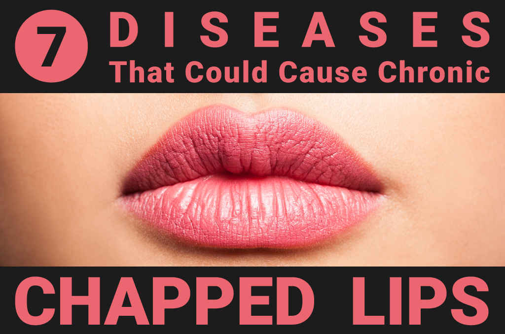 what causes chronic dry chapped lips