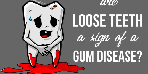 Are Loose Teeth A Sign Of A Gum Disease?