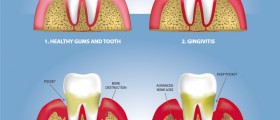 Are Red, Swollen, Or Sore, Bleeding Gums A Sign Of Gum Disease?