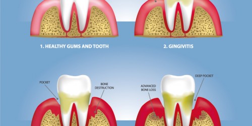 raised-bump-on-the-gum-after-tooth-extraction-oral-and-dental-health