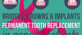 Bridges, Crowns and Implants: Permanent Tooth Replacement In Cancer Patients