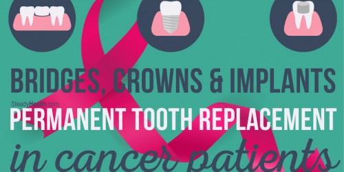 Bridges, Crowns and Implants: Permanent Tooth Replacement In Cancer Patients