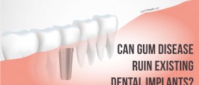 Can Gum (Periodontal) Disease Ruin Existing Dental Implants? Does It Make New Ones Impossible?