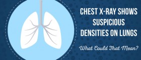 Chest X-Ray Shows Suspicious Densities on Lungs: What Could That Mean?
