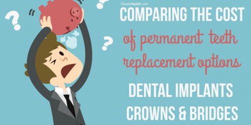 Comparing the Cost Of Permanent Teeth Replacement Options: Dental Implants, Crowns and Bridges