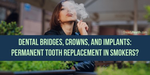 Dental Bridges, Crowns, And Implants: Permanent Tooth Replacement In Smokers?