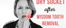 Dry Socket After Wisdom Tooth Removal