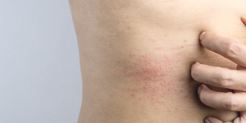 4 Things You Should Definitely Know About Skin Allergies