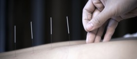 6 Things Multiple Sclerosis Patients Should Know About Acupuncture