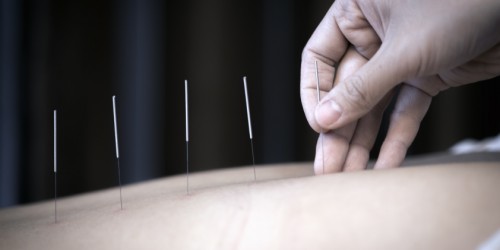 6 Things Multiple Sclerosis Patients Should Know About Acupuncture