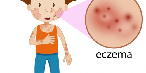6 Things You Should Know About Eczema (Atopic Dermatitis): Causes, Symptoms, Diagnosis And Treatment