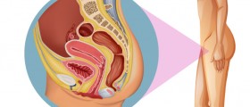 7 Things Women With PCOS Should Know About Endometrial Cancer