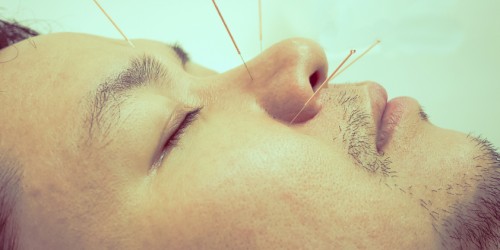 Acupuncture and Allergic Rhinitis: Is This A Safe and Effective Solution For Your Runny Nose?