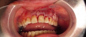 What is An Apicoectomy?