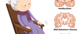 The 3 Stages of Alzheimer’s Disease: How Does the Disease Progress and Can You Stop It?