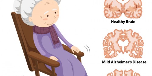 The 3 Stages of Alzheimer’s Disease: How Does the Disease Progress and Can You Stop It?