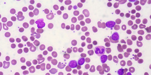 Common Autoimmune Disorders And How To Deal With Them