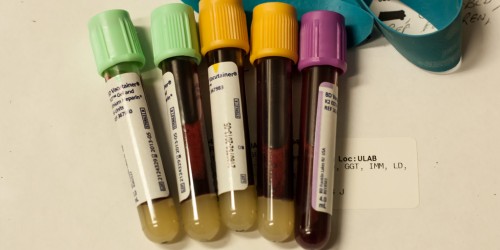 Not Enough Doctors, Limited Pain Treatment For People With Sickle Cell Trait